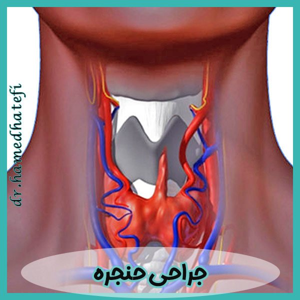 جراحی حنجره