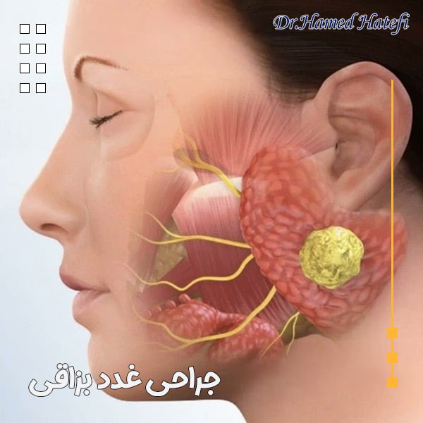 جراحی غدد بزاقی - دکتر حامد هاتفی