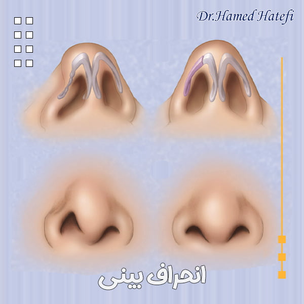 انحراف بینی - دکتر حامد هاتفی