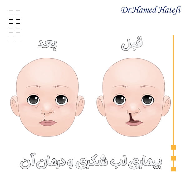 شکاف کام و راه درمان آن - دکتر حامد هاتفی