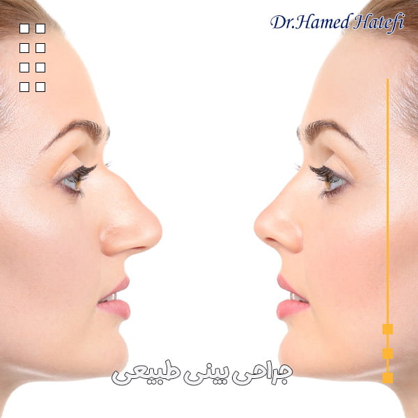 جراحی بینی طبیعی - دکتر حامد هاتفی