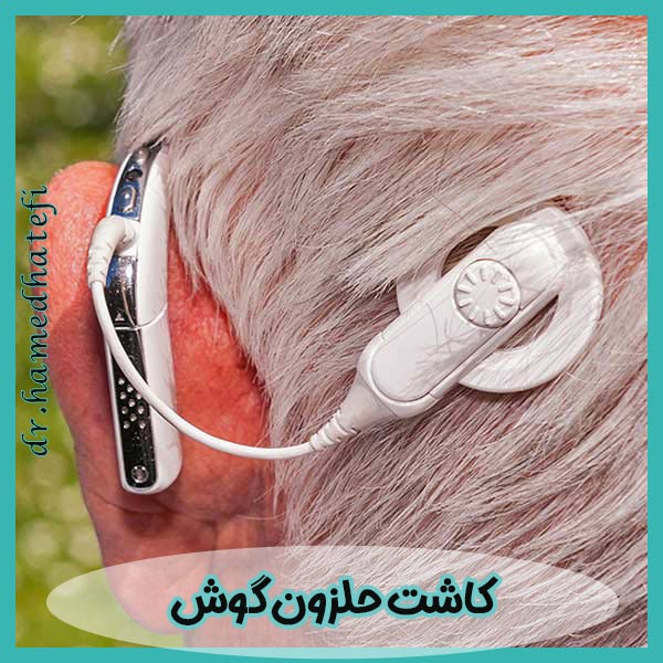 کاشت حلزون گوش