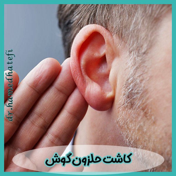 کاشت حلزون گوش