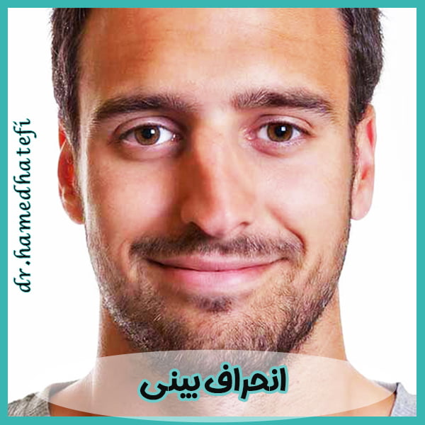 انحراف بینی