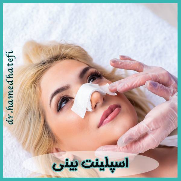 اسپلینت بینی - https://drhatefi.com/