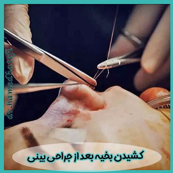 کشیدن بخیه بعد از جراحی بینی