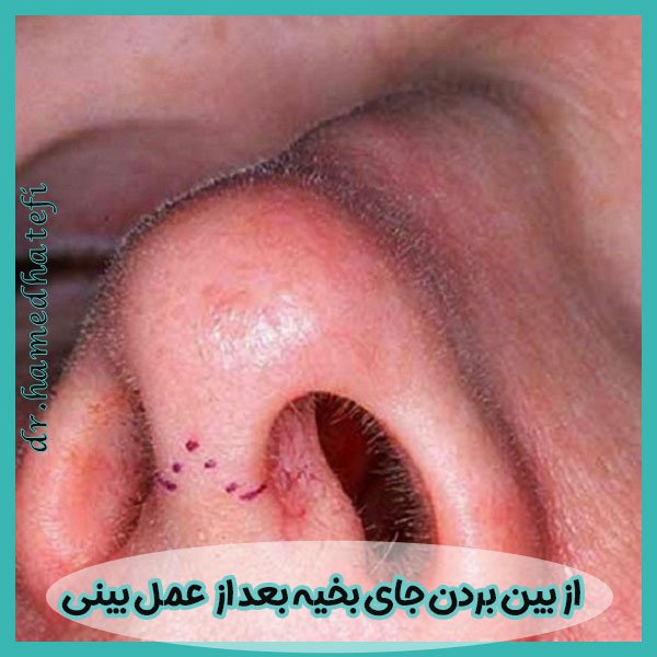 از بین بردن جای بخیه بعد از عمل بینی