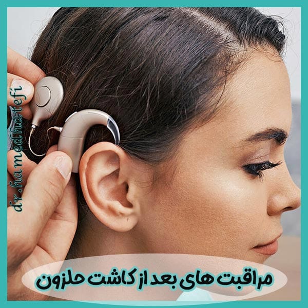 مراقبت های بعد از کاشت حلزون