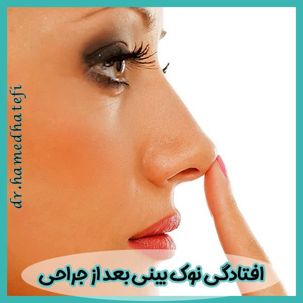 افتادگی نوک بینی بعد از جراحی