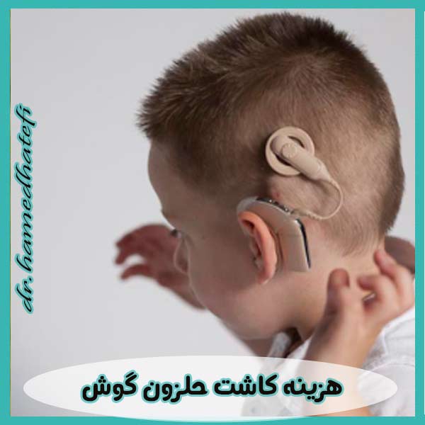 هزینه کاشت حلزون گوش