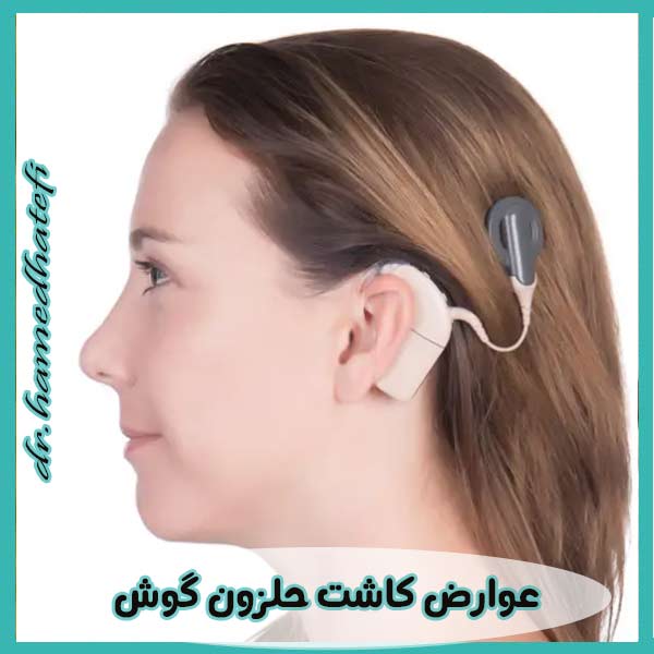 Complications of cochlear implantation
