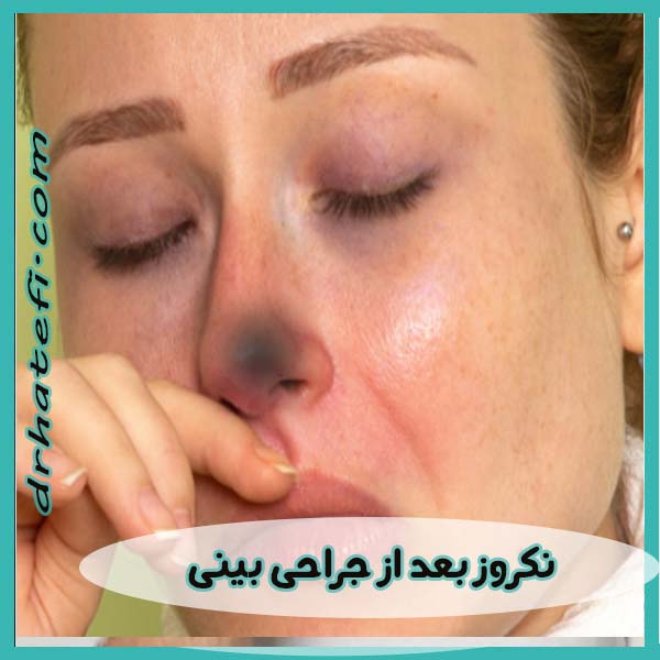 نکروز بعد از جراحی بینی