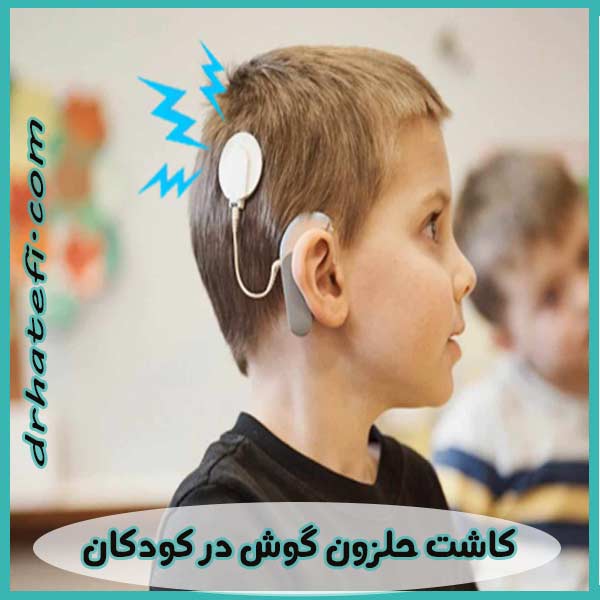 کاشت حلزون گوش در کودکان