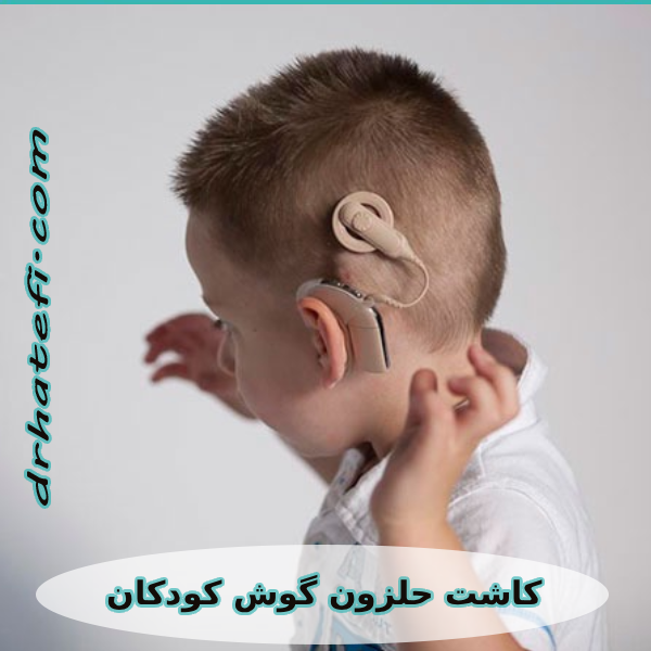 کاشت حلزون گوش کودکان _ دکتر حامد هاتفی
