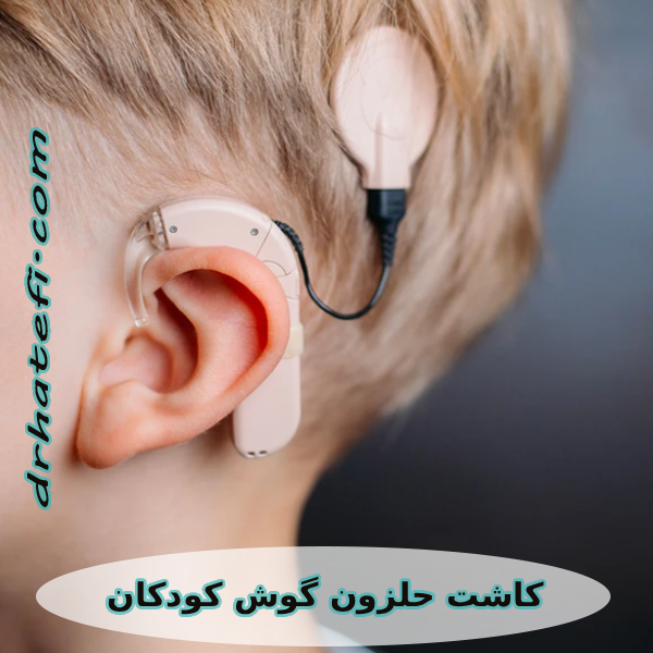 کاشت حلزون گوش کودکان _ دکتر حامد هاتفی