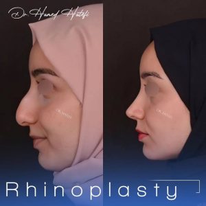 نمونه کارهای جراح بینی یزد _ دکتر حامد هاتفی