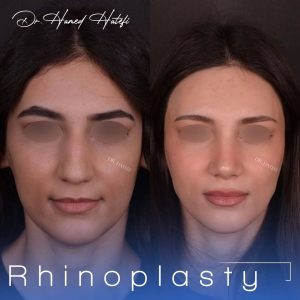 نمونه کارهای جراح بینی خوب در یزد _ دکتر حامد هاتفی