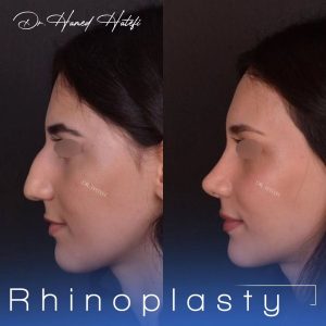 نمونه کارهای دکتر عمل بینی یزد _ دکتر حامد هاتفی
