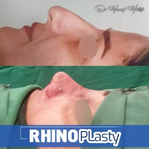 نمونه کار دکتر عمل بینی یزد _ دکتر حامد هاتفی