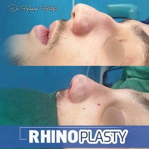 نمونه کار دکتر عمل بینی یزد _ دکتر حامد هاتفی