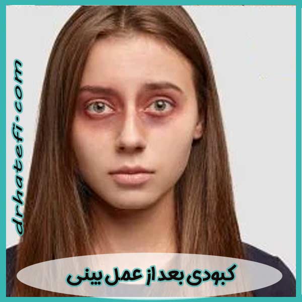 کبودی بعد از عمل بینی