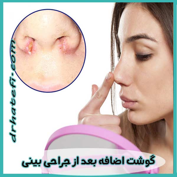 گوشت اضافه بعد از جراحی بینی