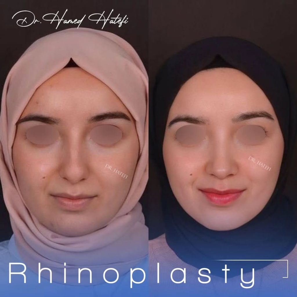 جراحی بینی