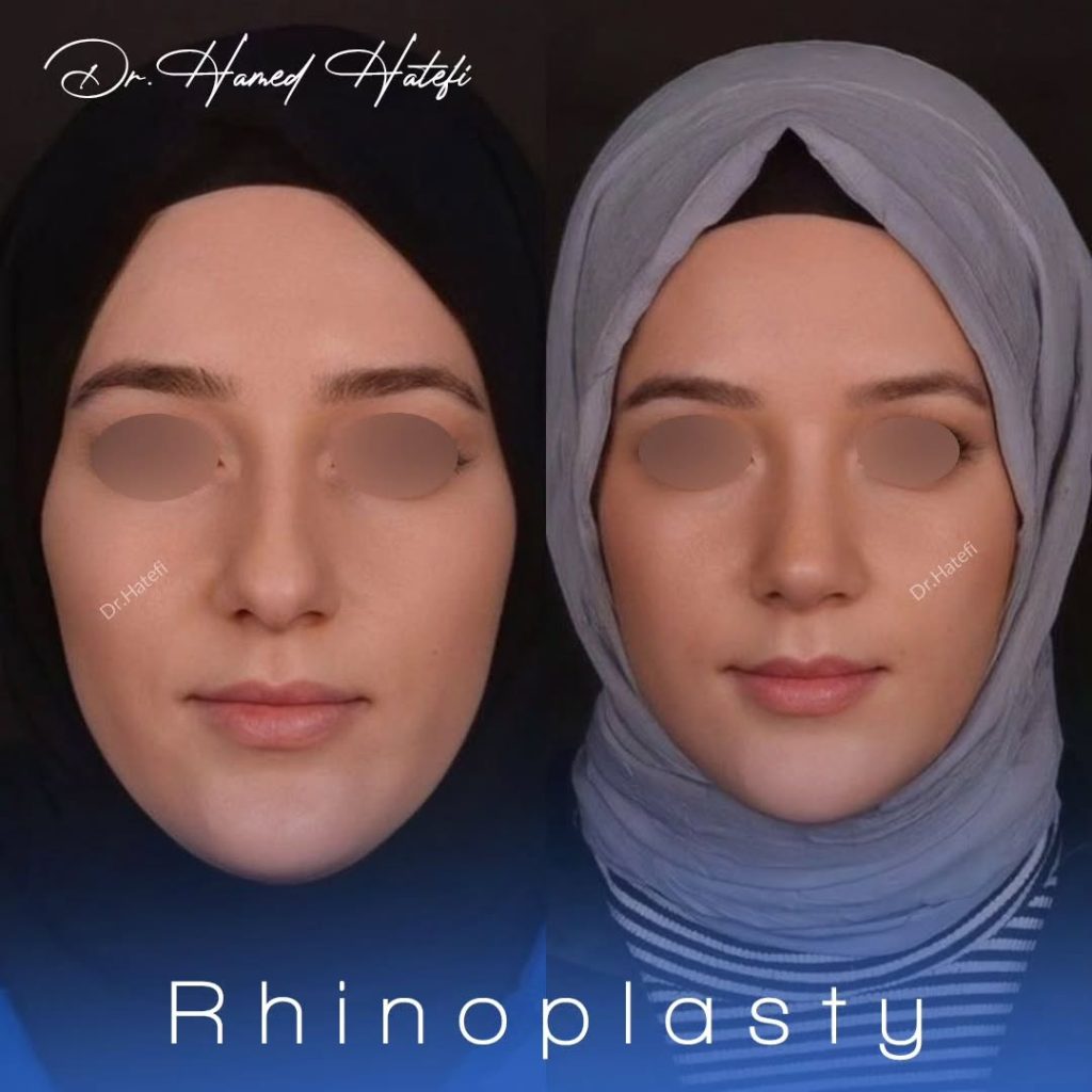 جراحی بینی