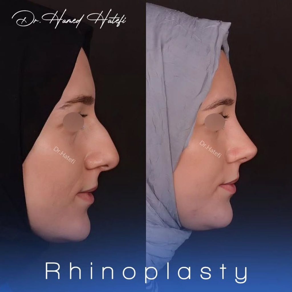 جراحی بینی