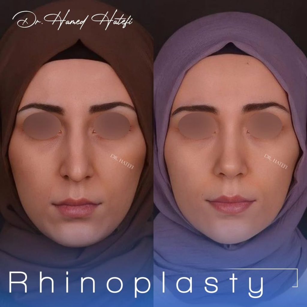 جراحی بینی
