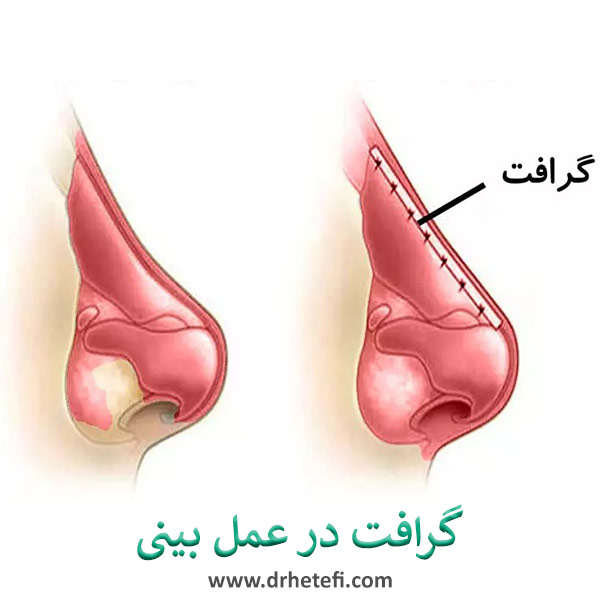 گرافت در عمل بینی _ دکتر حامد هاتفی