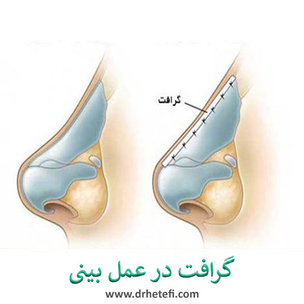گرافت در جراحی بینی _ دکتر حامد هاتفی