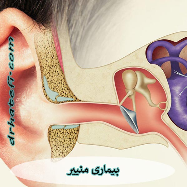 بیماری منییر گوش _ دکتر حامد هاتفی