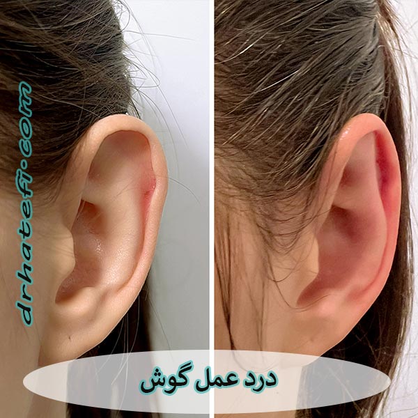 درد عمل گوش _ دکتر حامد هاتفی