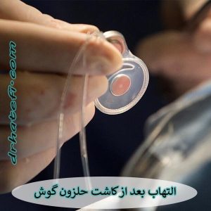 التهاب بعد از کاشت حلزون گوش _ دکتر حامد هاتفی