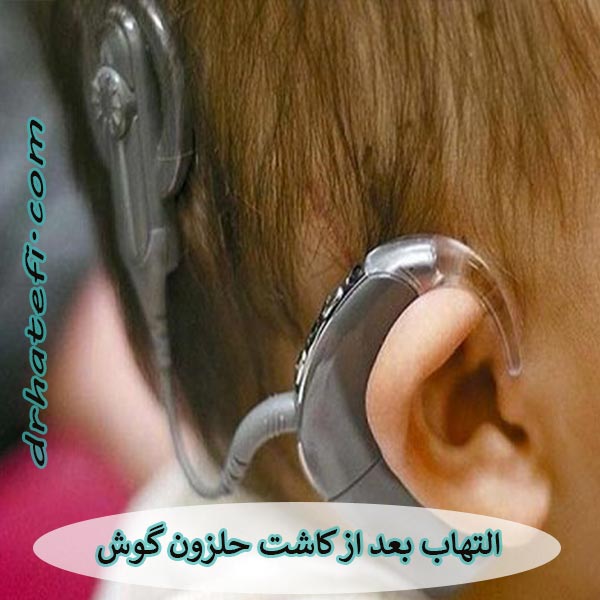 التهاب بعد از کاشت حلزون گوش _ دکتر حامد هاتفی