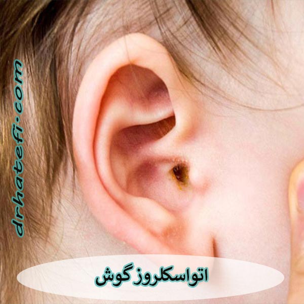 بیماری اتواسکلروز گوش _ دکتر حامد هاتفی