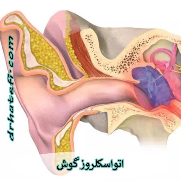 بیماری اتواسکلروز گوش _ دکتر حامد هاتفی